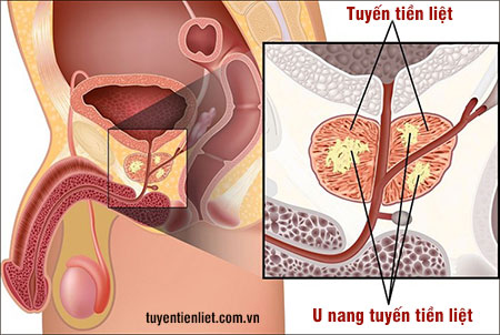 Phương pháp chẩn đoán nang tiền liệt tuyến 6mm là gì?
