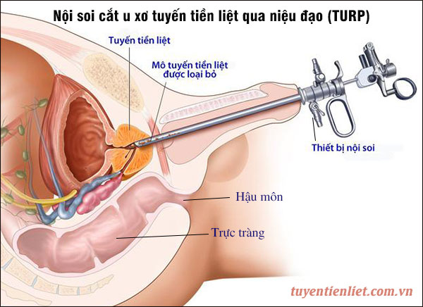 Mổ nội soi cắt u xơ tuyến tiền liệt qua niệu đạo (TURP) 1