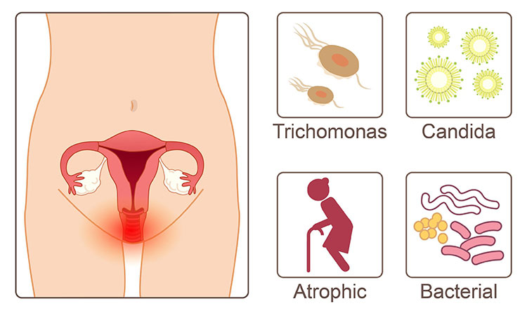 Nhiễm trùng hoặc kích ứng âm đạo ở nữ giới 1